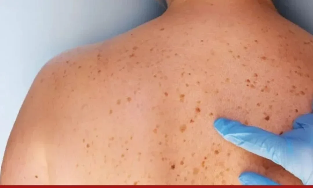 Best Skin Cancer Surgeons in India