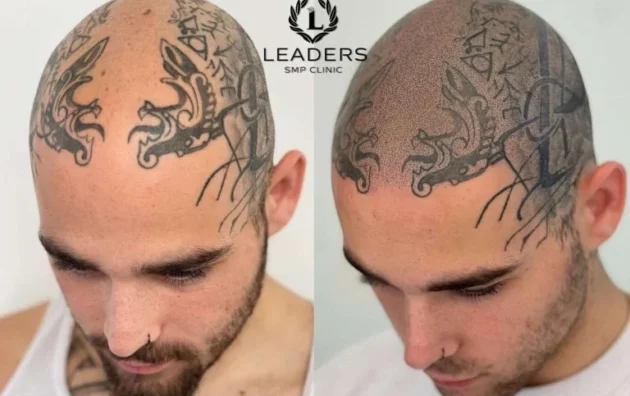 Picasso Scalp Micropigmentation